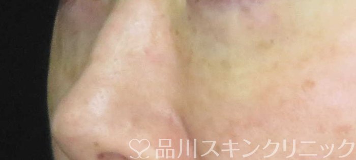 症例NO.65662のAFTER写真
