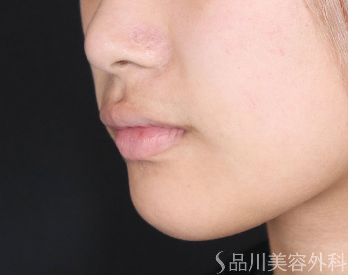 症例NO.72333のBEFORE写真