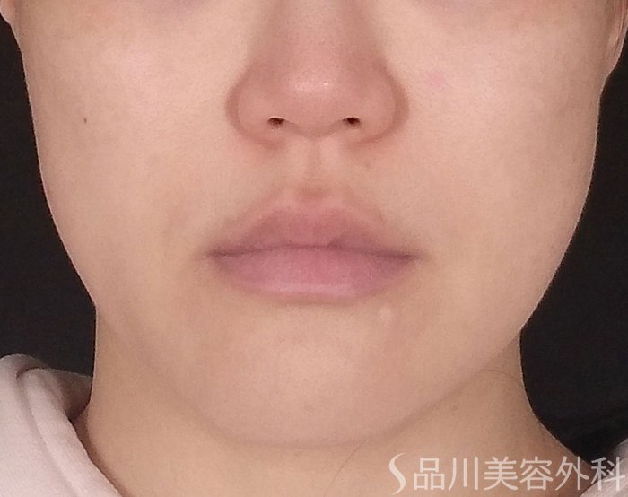 症例NO.70403のBEFORE写真