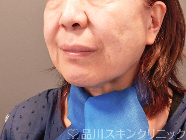 症例NO.71190のBEFORE写真