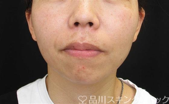 症例NO.61316のBEFORE写真