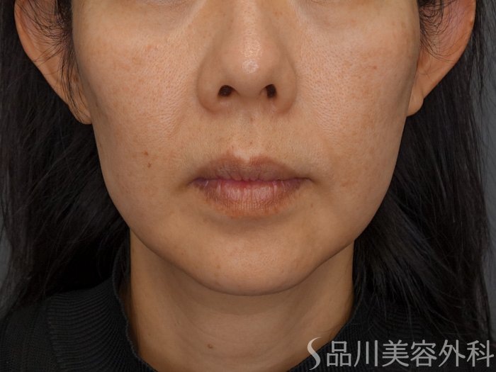 症例NO.74792のBEFORE写真