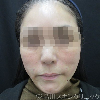 症例NO.64779のAFTER写真