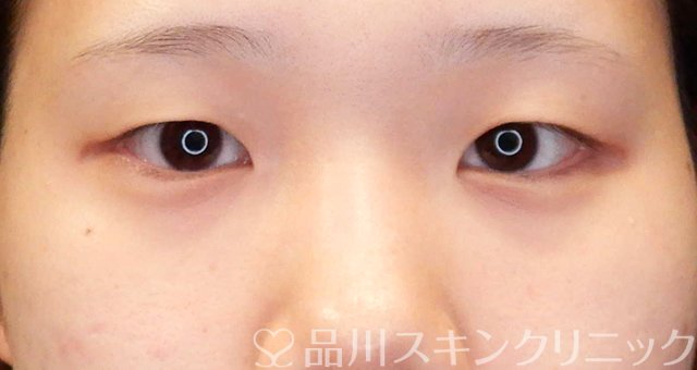 症例NO.66303のBEFORE写真