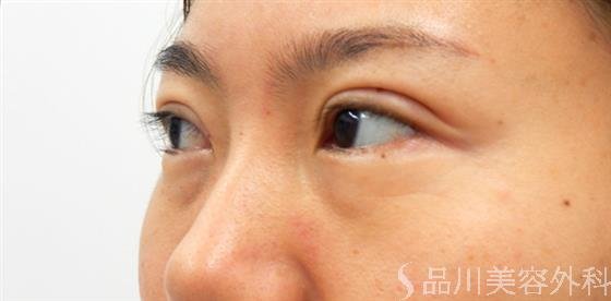 症例NO.53420のBEFORE写真