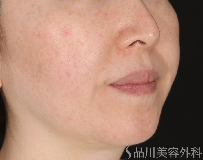 症例NO.72687のBEFORE写真