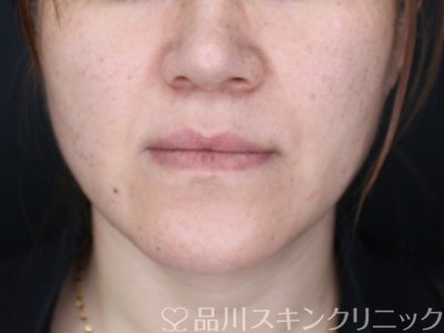 症例NO.64225のAFTER写真