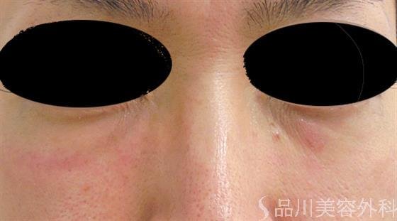 症例NO.46383のBEFORE写真