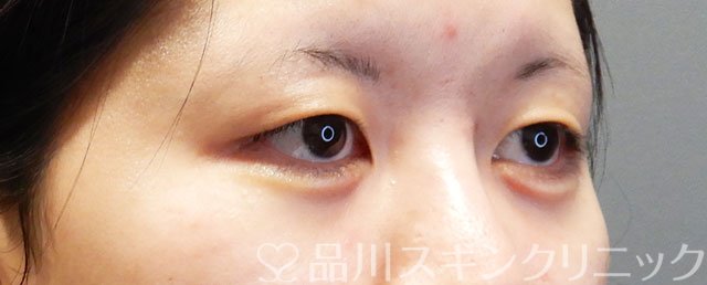 症例NO.74494のAFTER写真