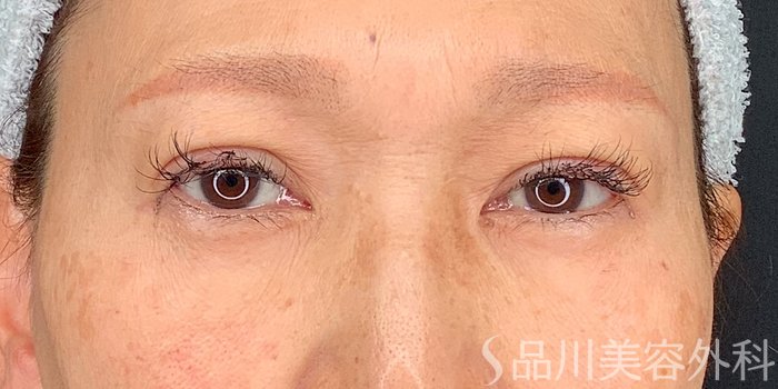 症例NO.71226のAFTER写真