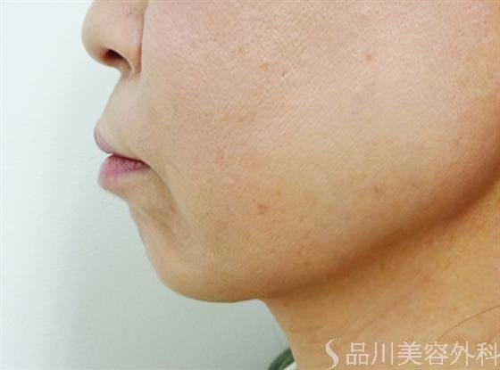 症例NO.34706のBEFORE写真