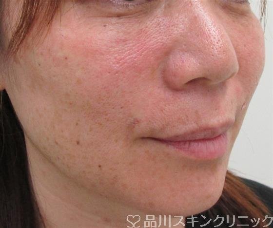 症例NO.30748のAFTER写真