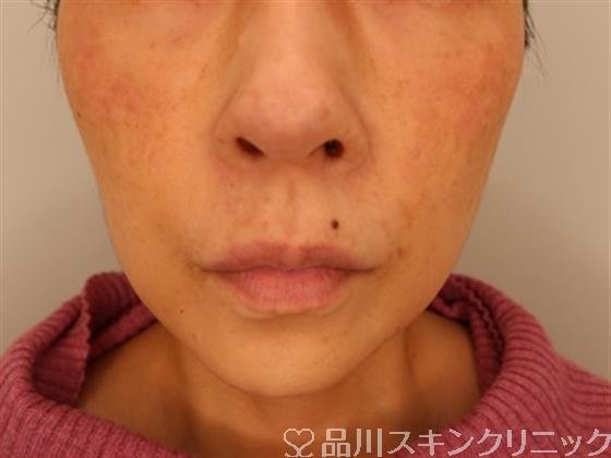 症例NO.50413のBEFORE写真