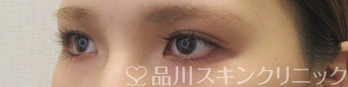 症例NO.70226のBEFORE写真