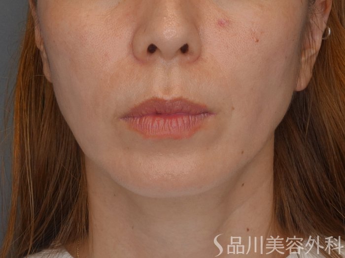 症例NO.72119のAFTER写真