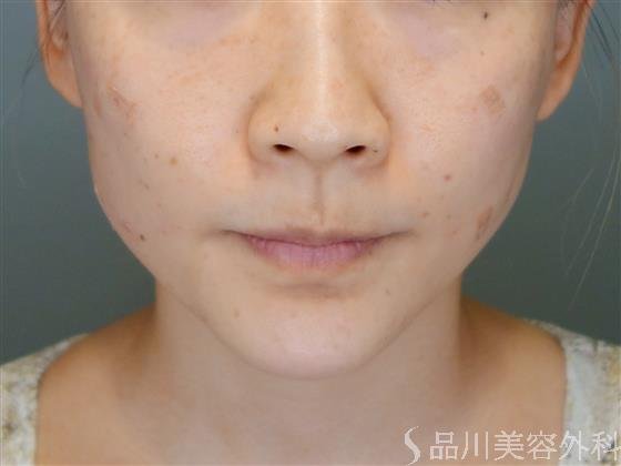 症例NO.52146のAFTER写真