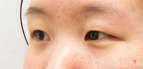 症例NO.54753のBEFORE写真