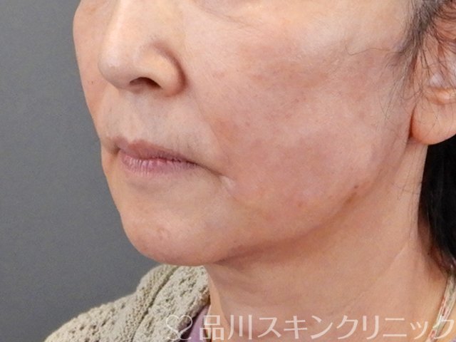 症例NO.75299のAFTER写真