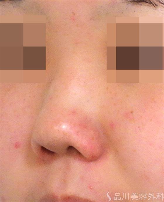 症例NO.39253のBEFORE写真