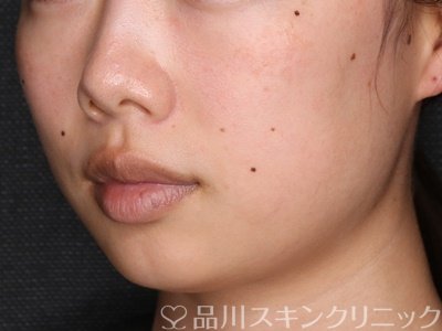 症例NO.73126のBEFORE写真