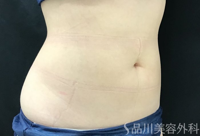 症例NO.68158のAFTER写真