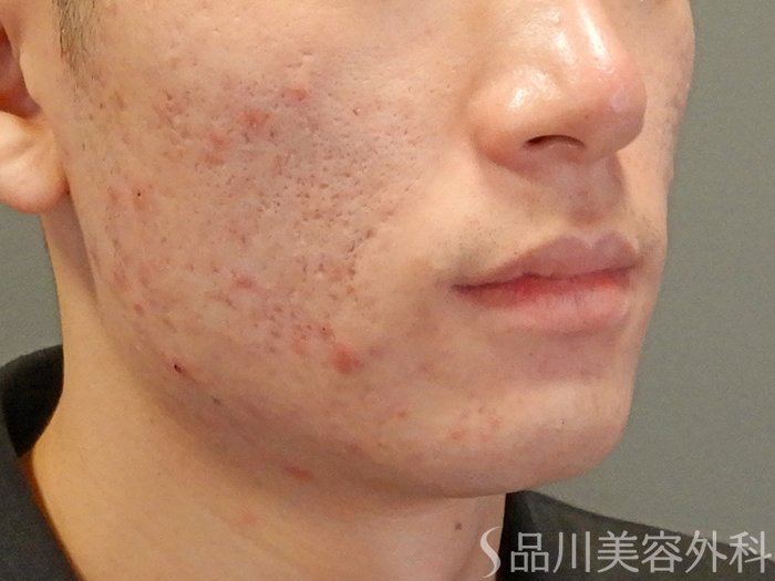 症例NO.71016のBEFORE写真