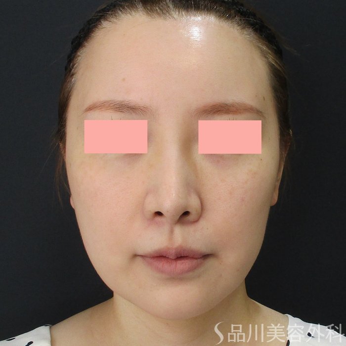 症例NO.72704のBEFORE写真