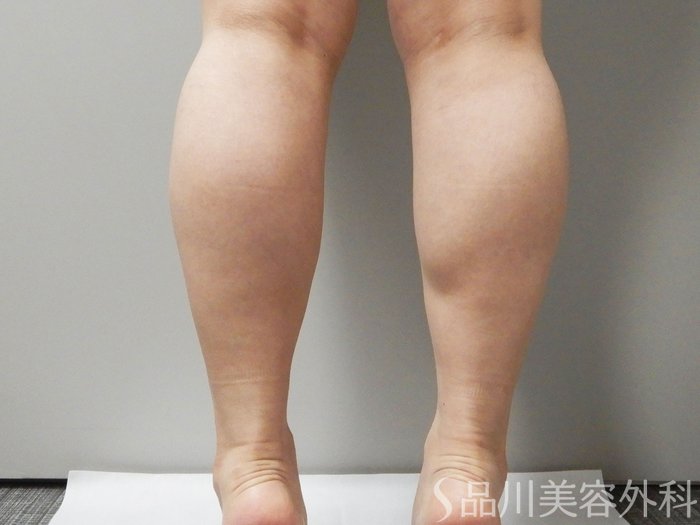 症例NO.71627のBEFORE写真
