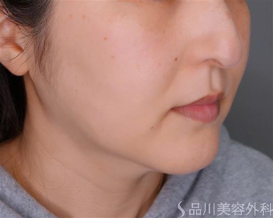 症例NO.54068のBEFORE写真