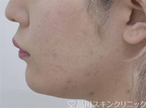 症例NO.53434のAFTER写真