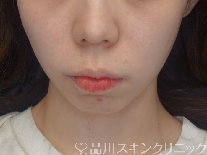 症例NO.74550のAFTER写真