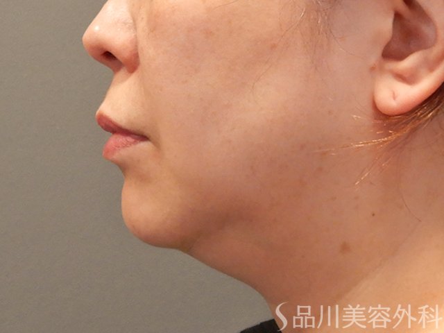 症例NO.75013のBEFORE写真