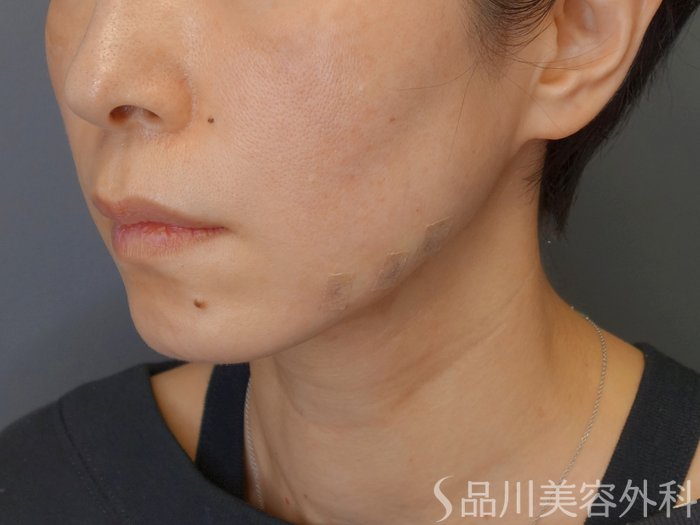 症例NO.72182のAFTER写真