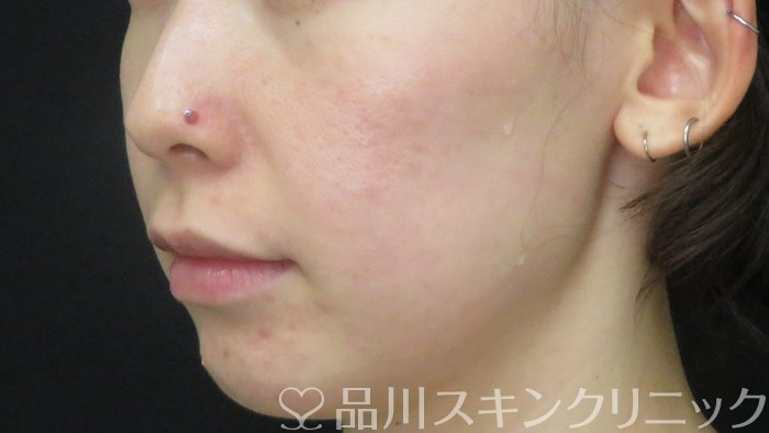 症例NO.71576のBEFORE写真