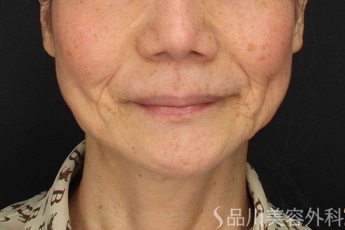 症例NO.64989のBEFORE写真