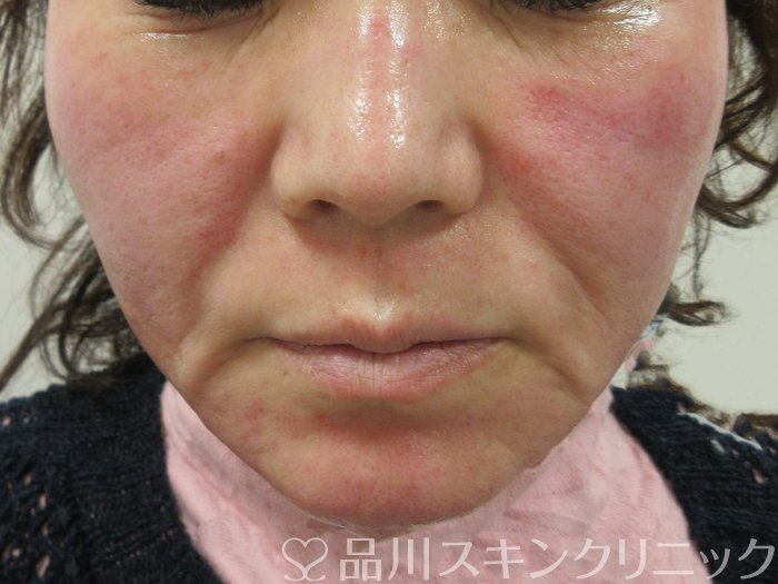 症例NO.72828のBEFORE写真