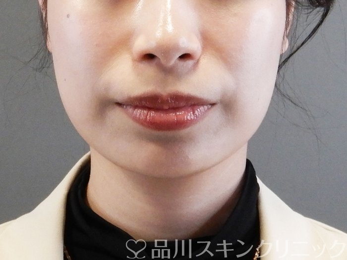 症例NO.64247のBEFORE写真