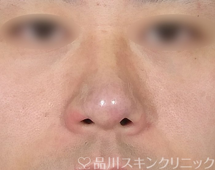 症例NO.64413のAFTER写真