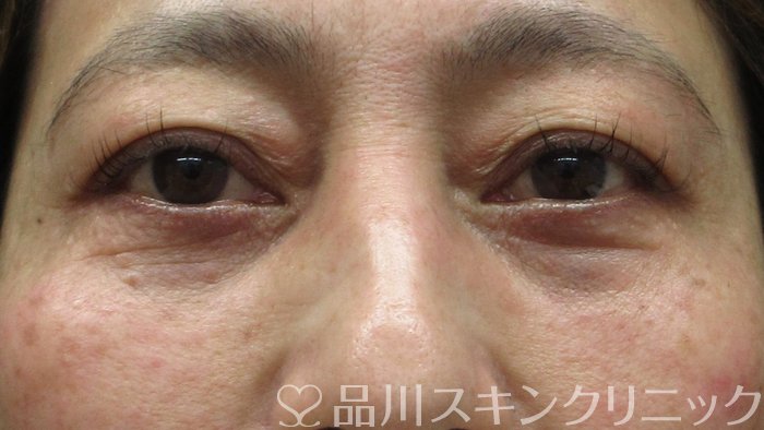 症例NO.70506のAFTER写真