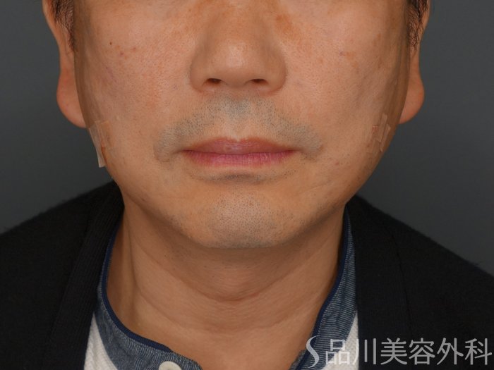 症例NO.74484のAFTER写真