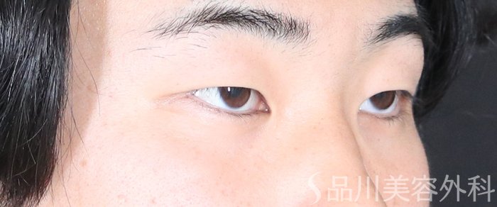 症例NO.73084のBEFORE写真