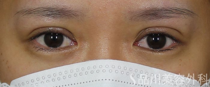 症例NO.69535のAFTER写真