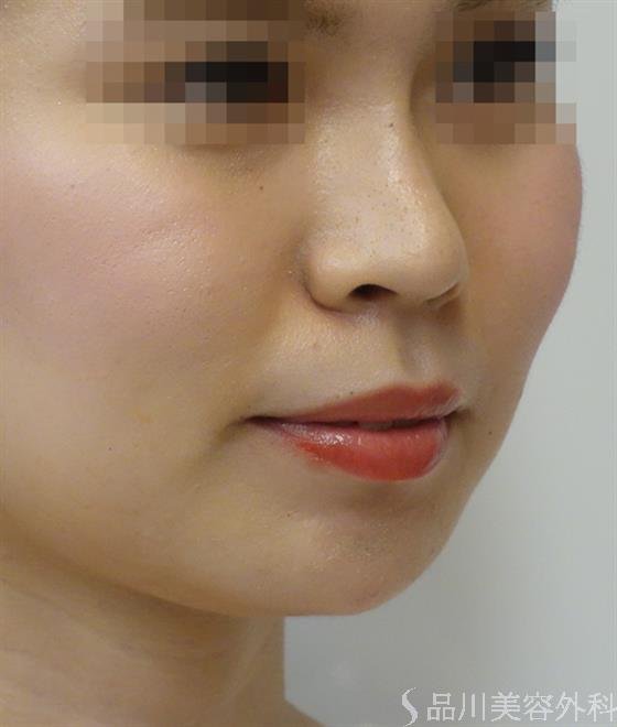 症例NO.36421のAFTER写真