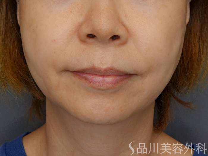 症例NO.71733のBEFORE写真