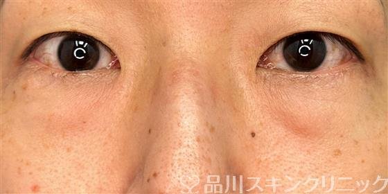 症例NO.61027のBEFORE写真