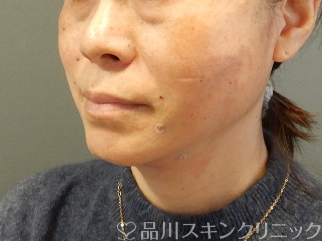 症例NO.63063のAFTER写真