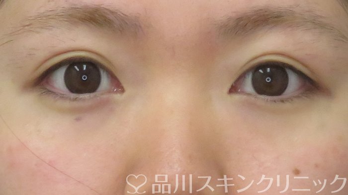 症例NO.71171のBEFORE写真