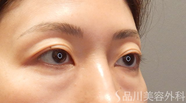 症例NO.73999のBEFORE写真