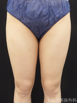 症例NO.70834のAFTER写真