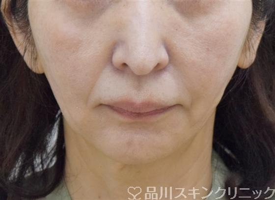 症例NO.58913のAFTER写真